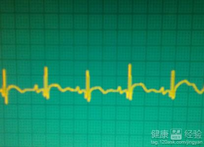 右束支傳導阻滯的飲食保健如何做好？