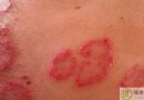 皮毛竇症狀全解析：成因、診斷與預防重點一次掌握