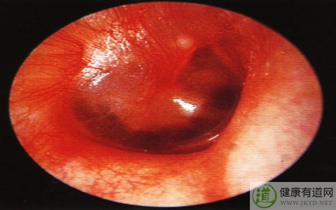 中耳炎嚴重嗎 中耳炎嚴重嗎