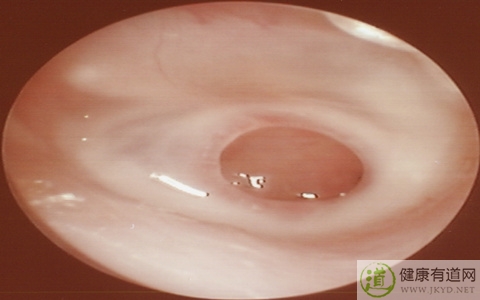 中耳炎嚴重嗎 中耳炎嚴重嗎