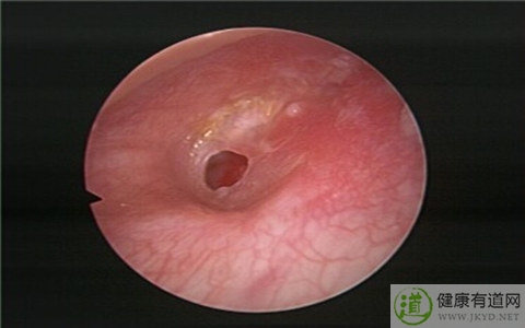 耳膜穿孔症狀 耳膜穿孔症狀