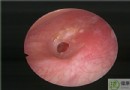 耳膜穿孔症狀全解析：成因、治療方法與預防護理完整指南