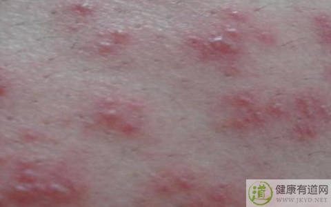 怎麼治療疱疹 怎麼治療疱疹