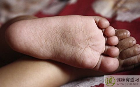 腳氣怎麼辦 腳氣怎麼辦