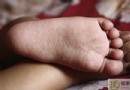 腳氣怎麼辦？7種居家療法與成因、影響全解析