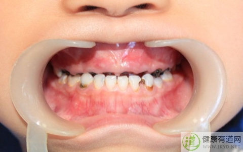 齲齒的形成 齲齒的形成