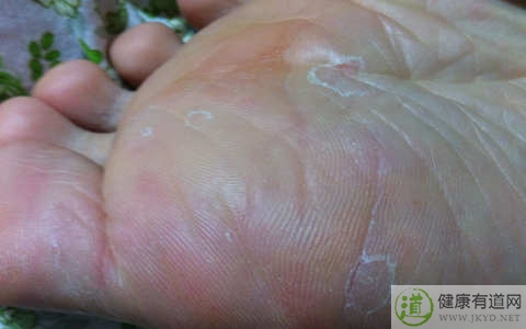 腳癬怎麼治 腳癬怎麼治