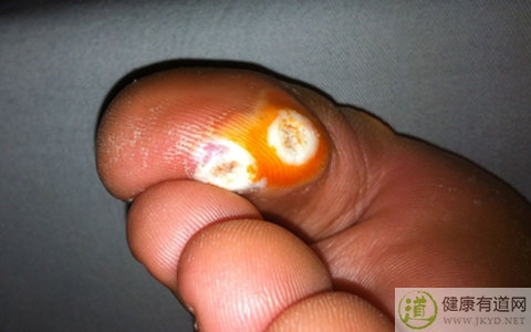 雞眼是什麼 雞眼是什麼