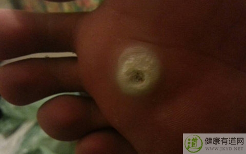 雞眼是什麼 雞眼是什麼