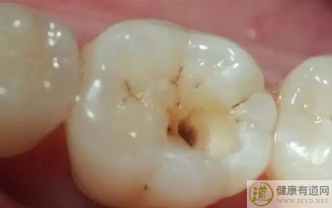 齲齒是什麼 齲齒是什麼