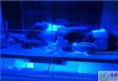 黃疸是什麼？認識黃疸的症狀、成因與治療方法