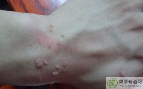 疣是什麼 疣是什麼