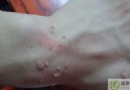 疣是什麼？認識疣的種類、危害與治療方法全解析
