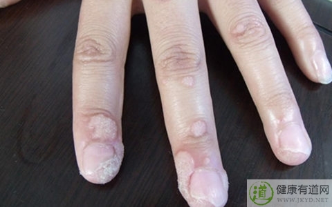 疣是什麼 疣是什麼