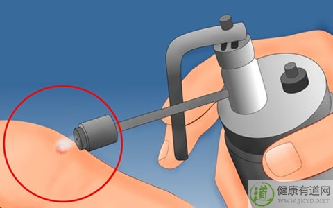 疣是什麼 疣是什麼