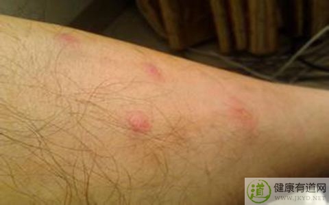 冬天皮膚搔癢怎麼辦 冬天皮膚搔癢怎麼辦