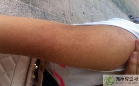 冬天皮膚搔癢怎麼辦 冬天皮膚搔癢怎麼辦