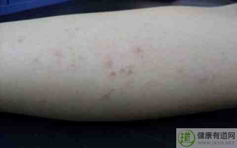 冬季皮炎怎麼辦 冬季皮炎怎麼辦