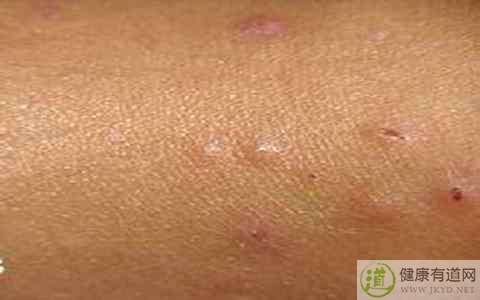 冬季皮炎怎麼辦 冬季皮炎怎麼辦