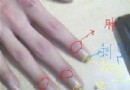 冬季手凍傷了怎麼辦？7種有效治療凍瘡的實用良方
