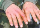 冬季凍傷後千萬別烤火！正確急救與預防方法全解析